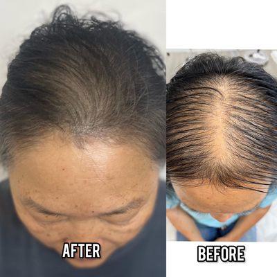 Last session for this client. Density treatment