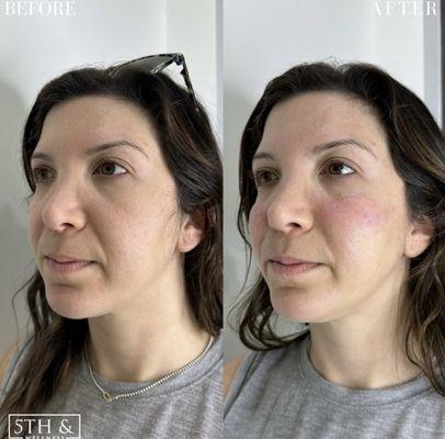 B&A Filler