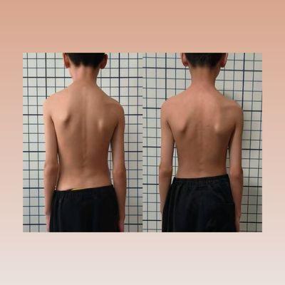 Uneven scapula due to scoliosis