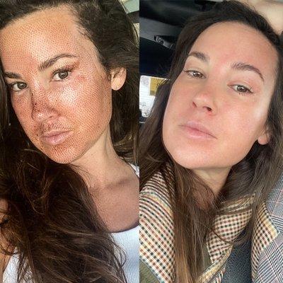 Full face fibroblast before and after