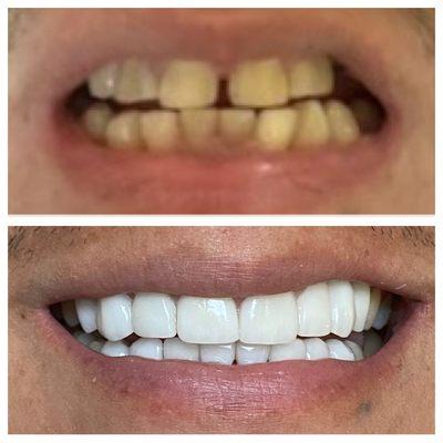 Smile transformation- before and after veneers!