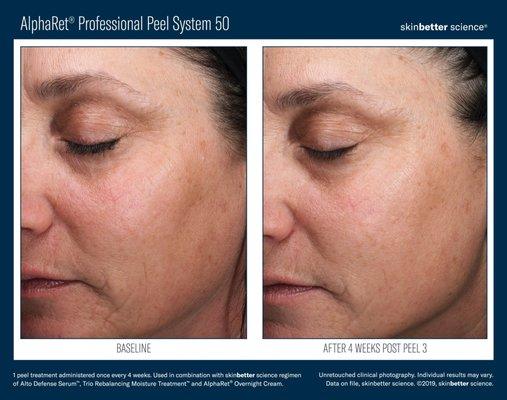 Benefits of a Skinbetter AlphaRet Professional Peel System