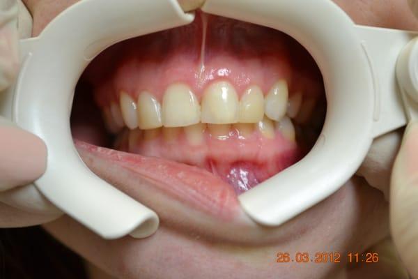 Porcelain Veneers Before 2