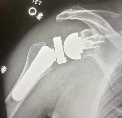 Reverse shoulder arthroplasty RSA