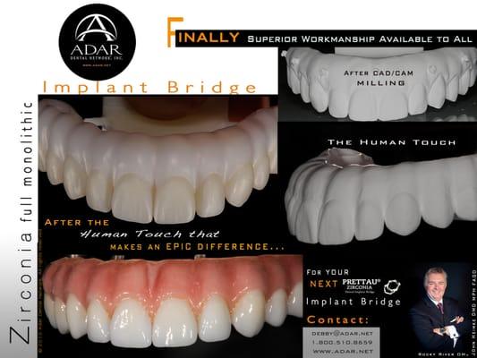 Prettau Implant Bridge