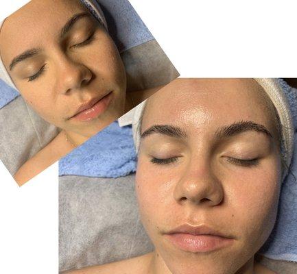 Microdermabrasion facial