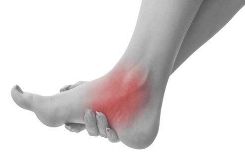 Plantar Fasciitis, Heel Spur