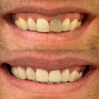 Porcelain crown placement to restore function and aesthetics