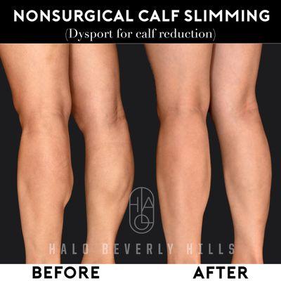 Calf slimming using dysport