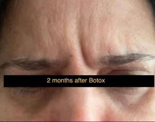 Botox which suppose to last 3-6 months is gone