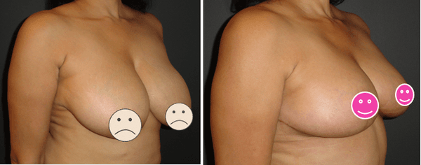 Dr. DeVito Breast Reduction Before and After