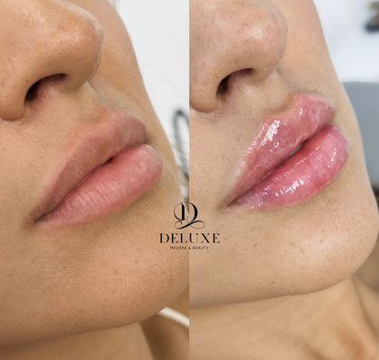 Lip augmentation