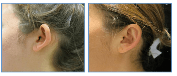 Cosmetic Ear Surgery - Otoplasty