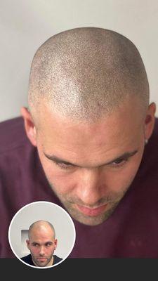 Here's a great example of another awesome Scalp Micropigmentation.