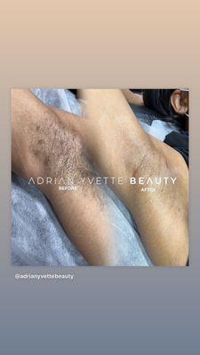 Underarm Wax Before and After