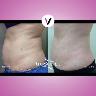 TruSulpt ID Results Are Visible After Just One Treatment. Safe, Effective and Comfortable.