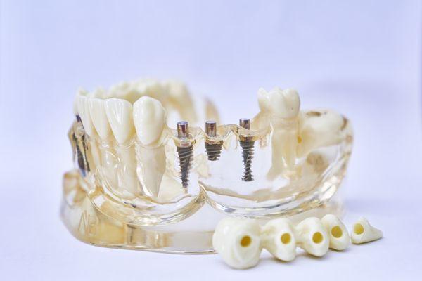 Dental crowns at their finest!