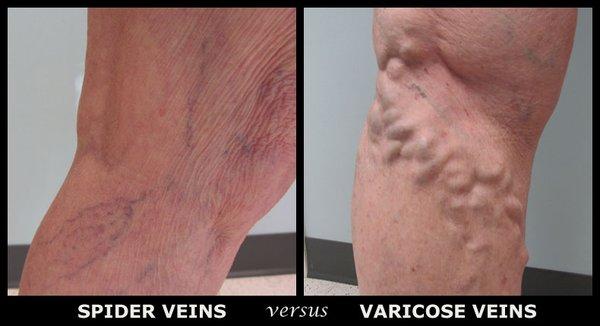 Suffer from bulging or spider veins? Find Relief at DVI