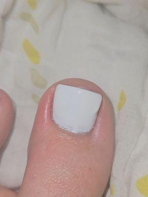 Infection from her ripping a large chunk of skin off the side of my toe