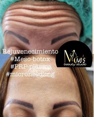 PRP &meso-botox