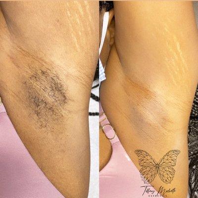 Underarm Sugaring results