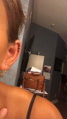 Not even 24 hrs later and the front of my ear looks better