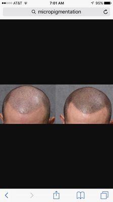 Scalp micro pigmentation also known as SMP after two sessions