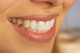 Your Smikle and chewing efficiency can be improved by Dental implant