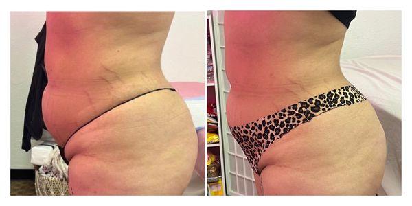 Before & After Cavitation