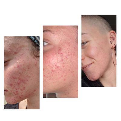 6 months from painful acne to clear skin