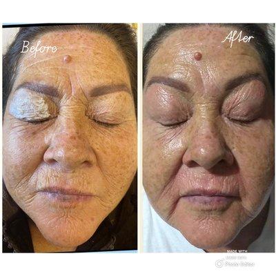 Plasma Fibroblast Upper-eyes. Client had a lot of excess skin which Claudia was able to tighten and lift the eyes.