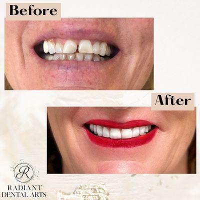 Check out this smile makeover! 
 Call to schedule a consultation today!