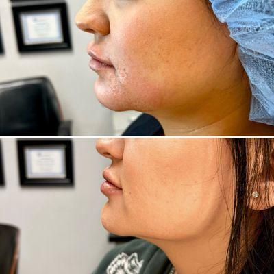 Jawline Contour and Lip augmentation. 2 syringes of Juvederm filler