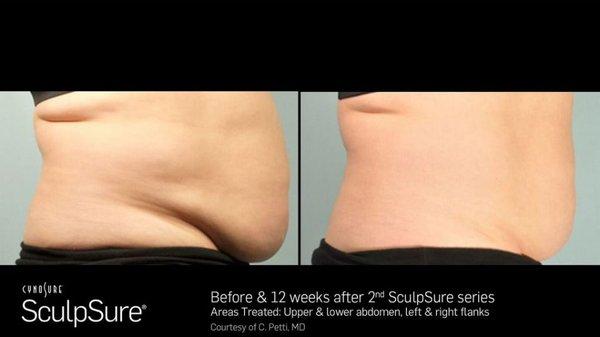 Want to get rid of stubborn fat but don't have time to go to the gym? Let Sollay get you in shape and fit before summer with no downtime!