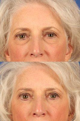 Blepharoplasty (Lower)