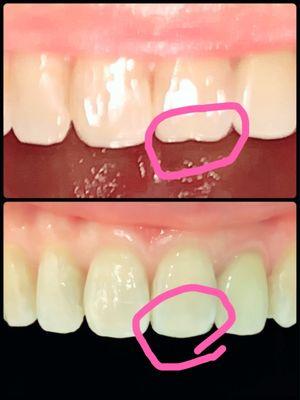 Dr Yang uses Carl Zeiss surgical microscope to do the amazing, delicate filling on my chipped front tooth.