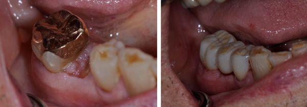 Middle broken tooth was removed and replaced with a porcelain bridge all in a SINGLE VISIT.