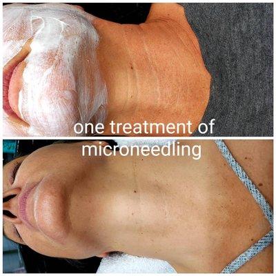 One treatment of microneedling