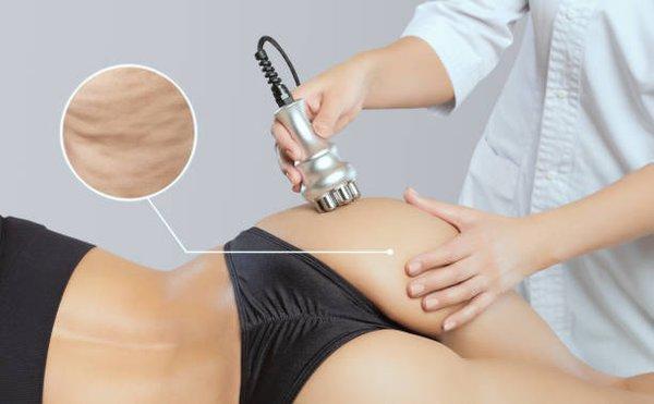 RF Therapy helps reduce appearance of wrinkles and stretch marks~