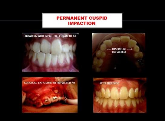 CASE 512: Impacted canine