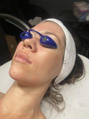 Lightening and Brightening Chemical Peel for hyperpigmentation.