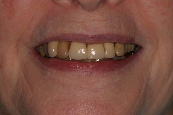 Before: Old, failing crowns and fillings.