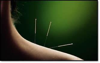 Traditional Chinese Acupuncture