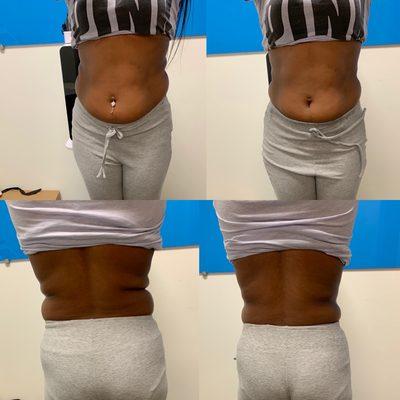 Non surgical back tightening and non surgical tummy tuck