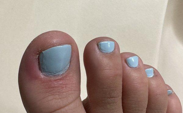 Infection after pedicure