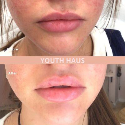 Lip Augmentation