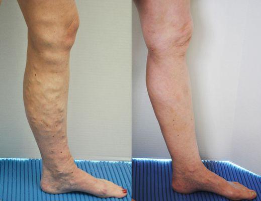 Varicose Vein Treatment--no down time.