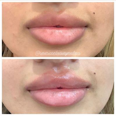 Non-injectable Fotona LipLase laser treatment for a plumper lips