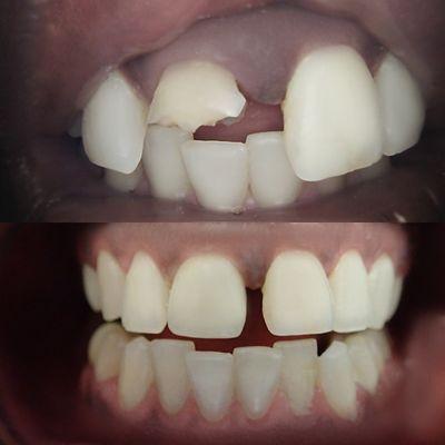 Before and after of teeth reconstruction