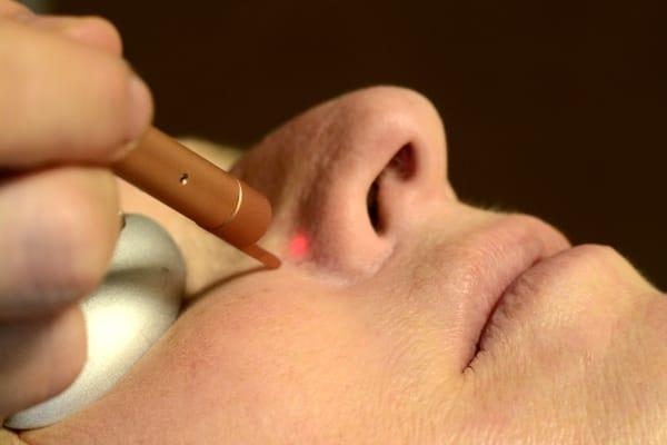 Gemini Laser to treat vessels on face and chest